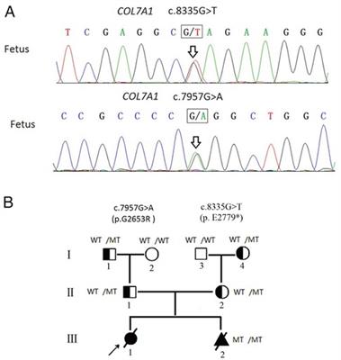 Genetic analysis and prenatal diagnosis of recessive dystrophic epidermolysis bullosa caused by compound heterozygous variants of the COL7A1 gene in a Chinese family